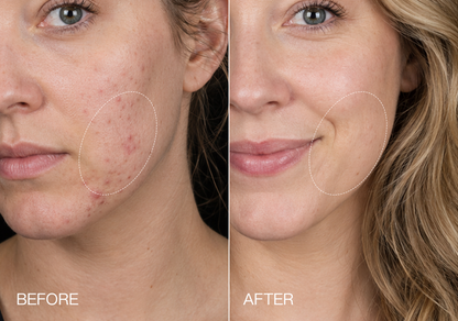 HEVELORA 7-Wavelength LED & NIR Skin Renewal Mask