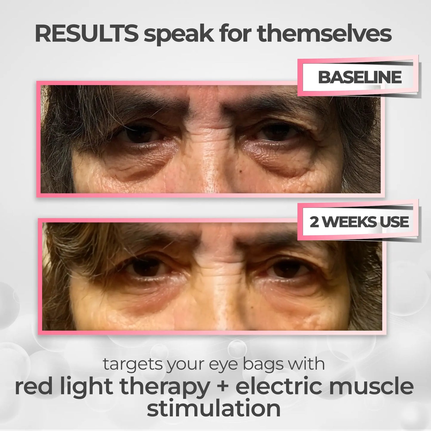 2-in-1 Red Light Therapy + EMS To Erase Eye Bags