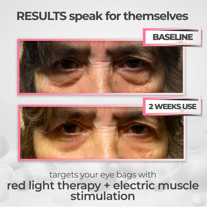 2-in-1 Red Light Therapy + EMS To Erase Eye Bags
